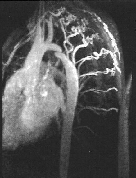 Coarctatio aortae 1944 Resektion + 1. End-to-end anastomos 2.