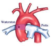 Fortsättning shunt kirurgi 1944 - Potts Shunt Willis Potts, Chicago (publicerat 1946) Waterston shunt