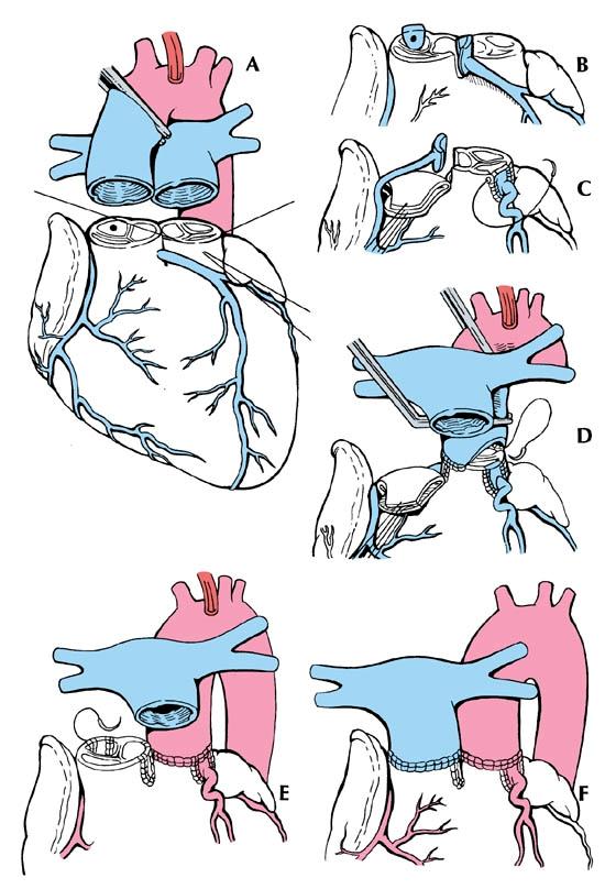 Hö pulmonalisgren framför Ao asc. Coronarkärlen måste flyttas.