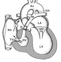 Problemen: Tricuspidalisatresi Biventrikulär kirurgisk korrigering ej