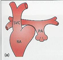 = Total Cavo Pulmonell Connection Lamellärt flöde mindre energiförlust