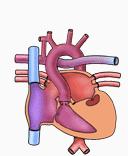 Hypoplastiskt vä kammarsyndrom också ett