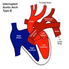 Ductus (PDA) beroende hjärtfel PDA försörjer systemcirkulationen Tät coarctatio aortae Avbruten aortabåge Hypoplastiskt vänsterkammar syndrom Kritisk, tät aortastenos PDA försörjer