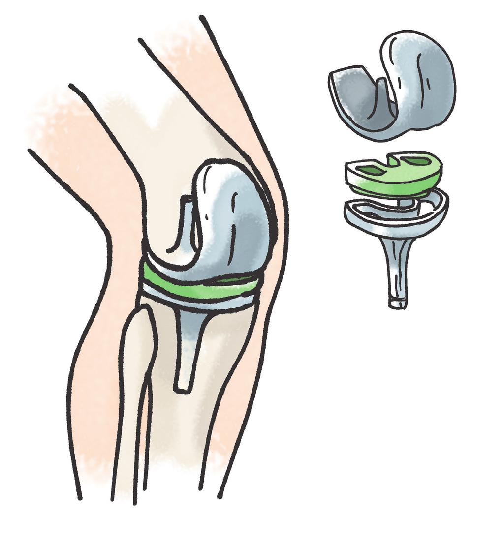 Operation med knäprotes Vid operation med knäprotes avlägsnas de sjuka ledytorna och man ersätter dem med konstgjorda ytor i form av en knäprotes.