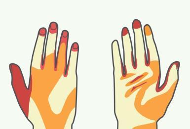 Handdesinfektion Kritiska områden vid handdesinfektion Bilden visar vilka områden som vi ofta slarvar med.