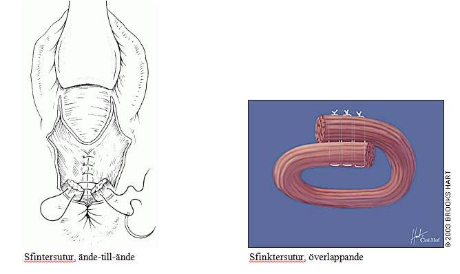 Sida 12 (25) Sutur av extern sfinkter Identifiera perimysium runt den externa sfinktern och de perineala musklerna. Oftast är den ena sidan mindre skadad och muskulaturen är blottad från denna sida.