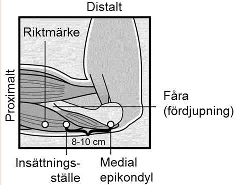 Ett implantat som satts in djupare än subdermalt (djup insättning) kan vara svårt att palpera och lokalisering och/eller uttag kan försvåras (se avsnitt 4.2 Hur man tar ut Nexplanon och avsnitt 4.4).
