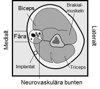 Insättning av Nexplanon ska utföras under aseptiska förhållanden och enbart av en läkare/barnmorska som är väl förtrogen med tekniken. Insättning ska endast ske med den förladdade applikatorn.