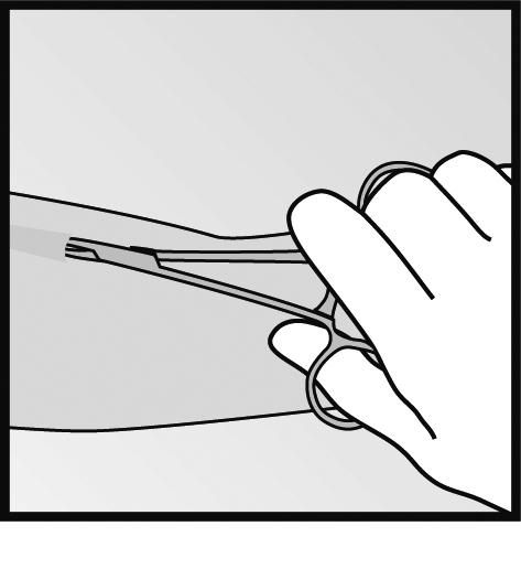 kan implantatet tas ut. Bild 15 Bild 16 Bild 17 Försäkra dig om att hela den 4 cm långa staven tagits ut genom att mäta den. Det har förekommit rapporter om trasiga implantat i patientens arm.