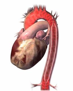 Placering Placeringen är viktig för korrekt funktion och för att undvika artärobstruktion. Katetern ska ligga med spetsen 1-2 cm nedom vänster arteria subclavias avgång från aorta.