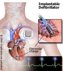 ICD (Implantable Cardiac