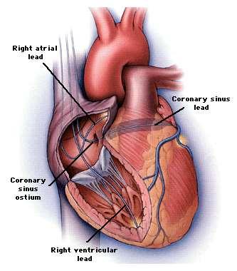 Biventrikulär pacing = CRT (Cardiac