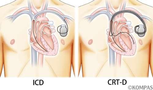 Implanted Cardiac Defibrillator Cardiac