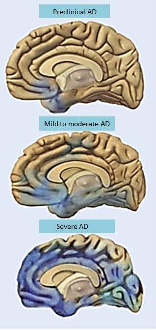 Förändringarna i hjärnan utvecklas gradvis Minnescentra i tinningloberna påverkas tidigt vid Alzheimers sjukdom