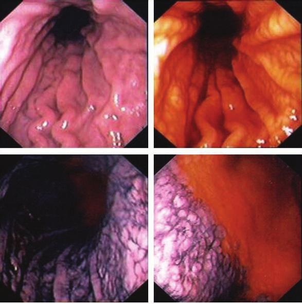 Sedvanlig endoskopi visar en blek, lätt upphöjd superficial (Type 0IIa) tumör med oklara gränser i antrum (Figur 13/1). Tumören är lilafärgad mot den normala gröna slemhinnan med AFE (Figur 13/2).