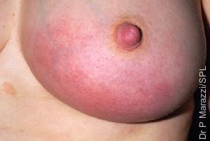 INFLAMMATION? (mjölkstockning? mastit?, abscess?