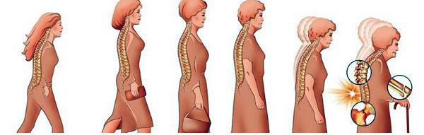 Osteoporos- till stor