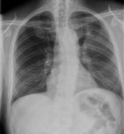 medicinska insatser multivisceral, Respiration efter det att döden inträtt Anestesi Fördelning/allokering