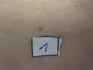 Fotografering Vid fotografering ska varje lesion numreras, antingen med nummerförsedd lapp som klistras bredvid lesionen, eller direkt på hud bredvid lesionen (bild 1). (bild 1) 1.