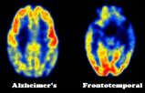 42 + total-tau + phospho-tau Amyloid-PET med 18F-flutemetamol Samband mellan förekomst av amyloida plack i cortex (F-flutemetamol uptake) och Mini mental test r = -0.