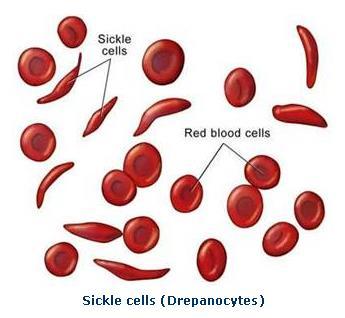 HbS - Sickle cell hemoglobin Mutation i beta-globingenen ger förändrad struktur och förändrade fysikaliska egenskaper Heterozygoti ( sickle cell trait ) ger knappast risk