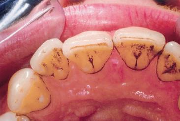 SUBGINGIVAL TANDSTEN.