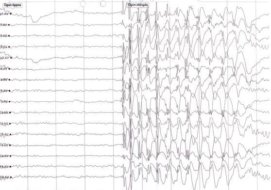 5. På bilden nedan ser du ett EEG. a. Vad visar detta för sorts epilepsi? 1p b. Beskriv hur dessa anfall uttrycker sig och vilka som oftast drabbas av detta. 3p 6.