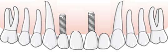 konstruktion, exempelvis en helbro. Sammanbunden konstruktion Samma behandling med separata konstruktioner Bilden till vänster ovan visar en sammanbunden konstruktion mellan tänder och implantat.