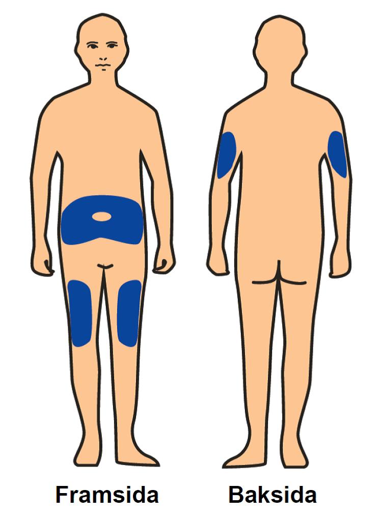 Benepali förfylld spruta är avsedd för subkutan injektion. Den ska injiceras i låret, buken eller baksidan av överarmen (se bild till vänster). Byt ställe för varje injektion.