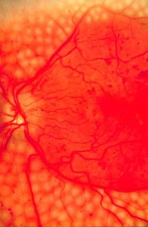 Förändring av ögon-diagnosklassificering 2018 Efter initiativ från ögonläkarföreningen och i samråd med SFD har NDR bytt klassificering av retinopati-diagnoserna.