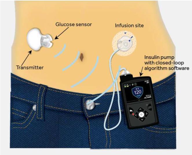 mmol/l i blodglukos, vilket sker automatiskt genom att insulin upp- eller nedregleras utefter behov. Målvärdet kan vid behov temporärt justeras upp till 8,3 mmol/l exempelvis vid träning.