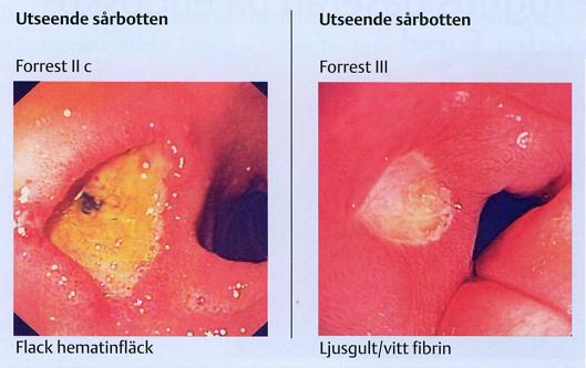 Revisionshistorik: Utgåva Revisionsdatum: Kommentar: nr: Godkänd av (namn, titel, datum): 1 2006-08-16 Första utgåvan Stefan Redéen, Läkare, 061004 2 2007-03-29 Reviderad utgåva.