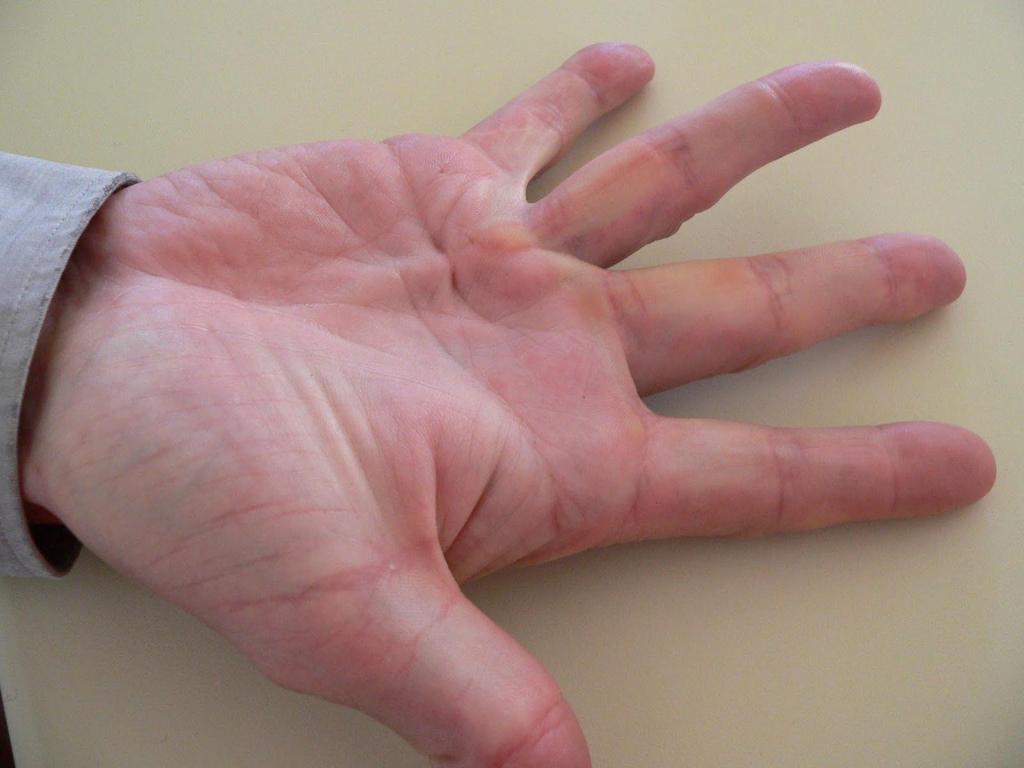 STATUS: Palpabel ärrsträng volart i handflatan och ut på fingret/fingrarna. Passiv och aktiv sträckdefekt i någon av fingrets/fingrarnas leder.