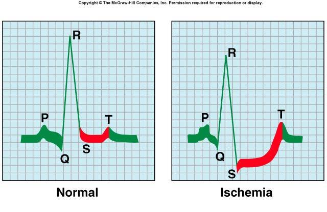 EKG: