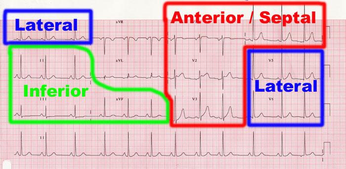 EKG: