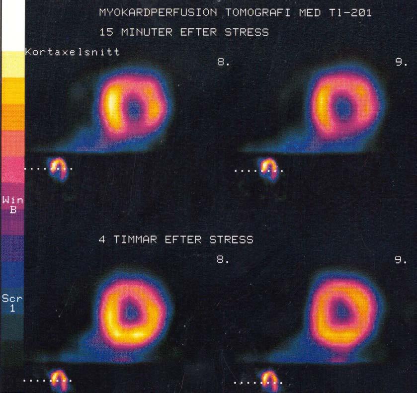 Myokardscint exempel Två