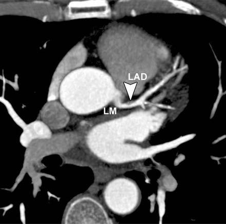 (a) RAO view along the interventricular groove shows LAD, with mixed