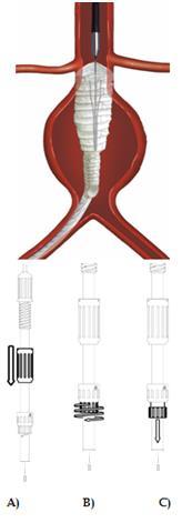 Deponering av huvudkroppens aortadel Deponering av det ipsilaterala benet Deponering av graftens aortadel: A) Dra tillbaka