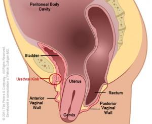 bulging 1 year after surgery and a total of 89 % were satisfied with the result of the operation. The vaginal hysterectomy group had a higher rate of severe complications than the * Ida Bergman ida.