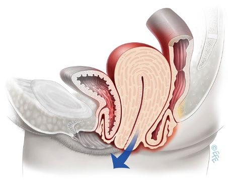 Apikalt Cervix/uterus eller vaginaltopp Cervixelongation uterovaginal prolaps- Inkomplett/ komplett =