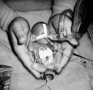 Hon vägde bara 260 gram när hon föddes 1996, men läkarna kunde ändå rädda Glenna Bernice Mitchell till livet. Källa: Aftonbladet.se Uppgift - Abort 1. a) Sedan 1975 har vi fri abort i Sverige.