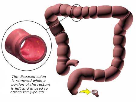Ulcerös Kolit (UC) Inflammationen drabbar endast kolomucosan. Med ytterst få undantag omfattas alltid rektum med en kontinuitet oralt åt.
