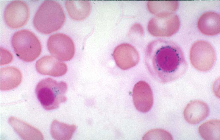 Några definitioner Blast (myeloblast) àomogen cell i benmärgen.