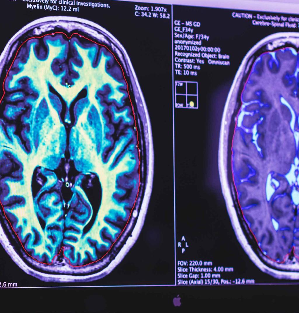 We re imaging the future of quantitative MRI Innehåll SyMRI i korthet...4 Vd har ordet...6 Året i korthet...8 Strategi och vision...10 Case study: Sturge-Weber...11 Magnetisk resonanstomografi.