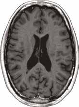 Magnetisk resonanstomografi Så funkar MRI OM TEKNIKEN Magnetisk resonanstomografi Magnetisk resonanstomografi (MR) är en avancerad form av medicinsk bilddiagnostik där ett magnetiskt fält används för