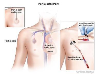 Port-a-cath - skötsel Patient med cytostatikabehandlad bröstcancer kommer för omläggning av port-a-cath