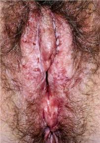 Kondylom- HPV humant papillomvirus 6 och 11 Finns