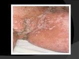 diatermi Kondylom- HPV humant papillomvirus