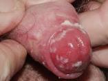 Candida albicans Candida balanitis (inflammation på