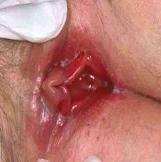 antimycoticum lokalt, salva eller vagitorier,
